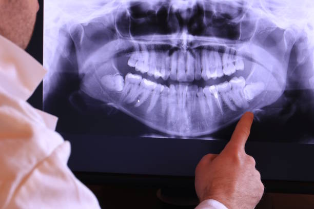 Best Emergency Wisdom Teeth Removal in Deerfield, WI