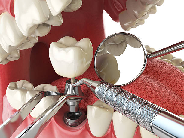Best Emergency Root Canal Treatment in Deerfield, WI